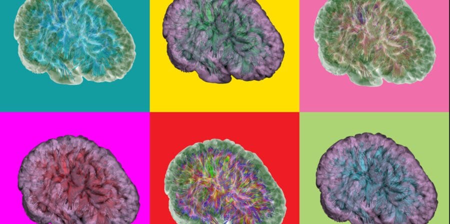 Brain changes Alzheimer's Kenneth Rostowsky