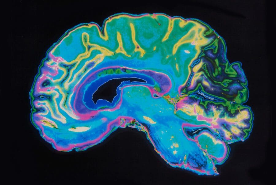 Colorful image of a brain scan showcasing different brain areas in vivid colors