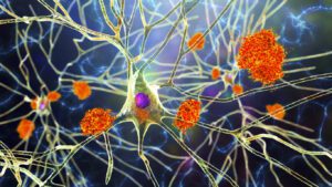 Neurons in Alzheimer's disease. 3D illustration showing amyloid plaques in brain tissue, neurofibrillary tangles and destruction of neuronal networks