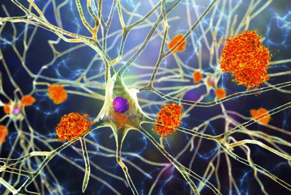 Neurons in Alzheimer's disease. 3D illustration showing amyloid plaques in brain tissue, neurofibrillary tangles and destruction of neuronal networks